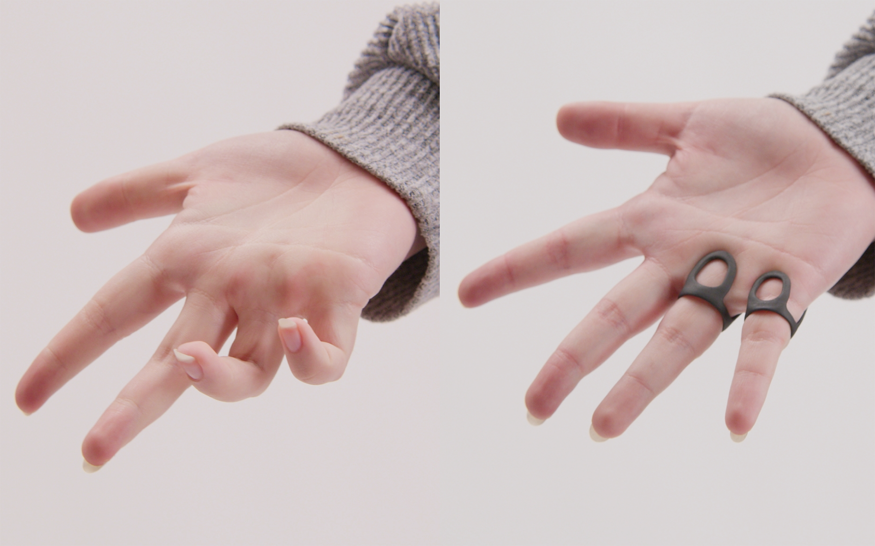 Mano con dito contratto e supporto per dito; confronto di utilizzo per migliorare la posizione delle dita.